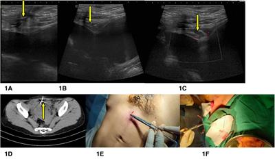 Case report: An intrauterine device hugging the musculus rectus abdominis through the center of a cesarean scar